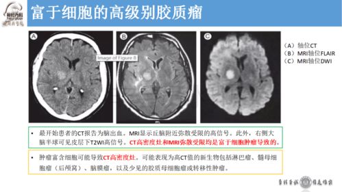 百度蜘蛛池租用:顱后池增大與蜘蛛網(wǎng)膜病變，臨床診斷與治療探討